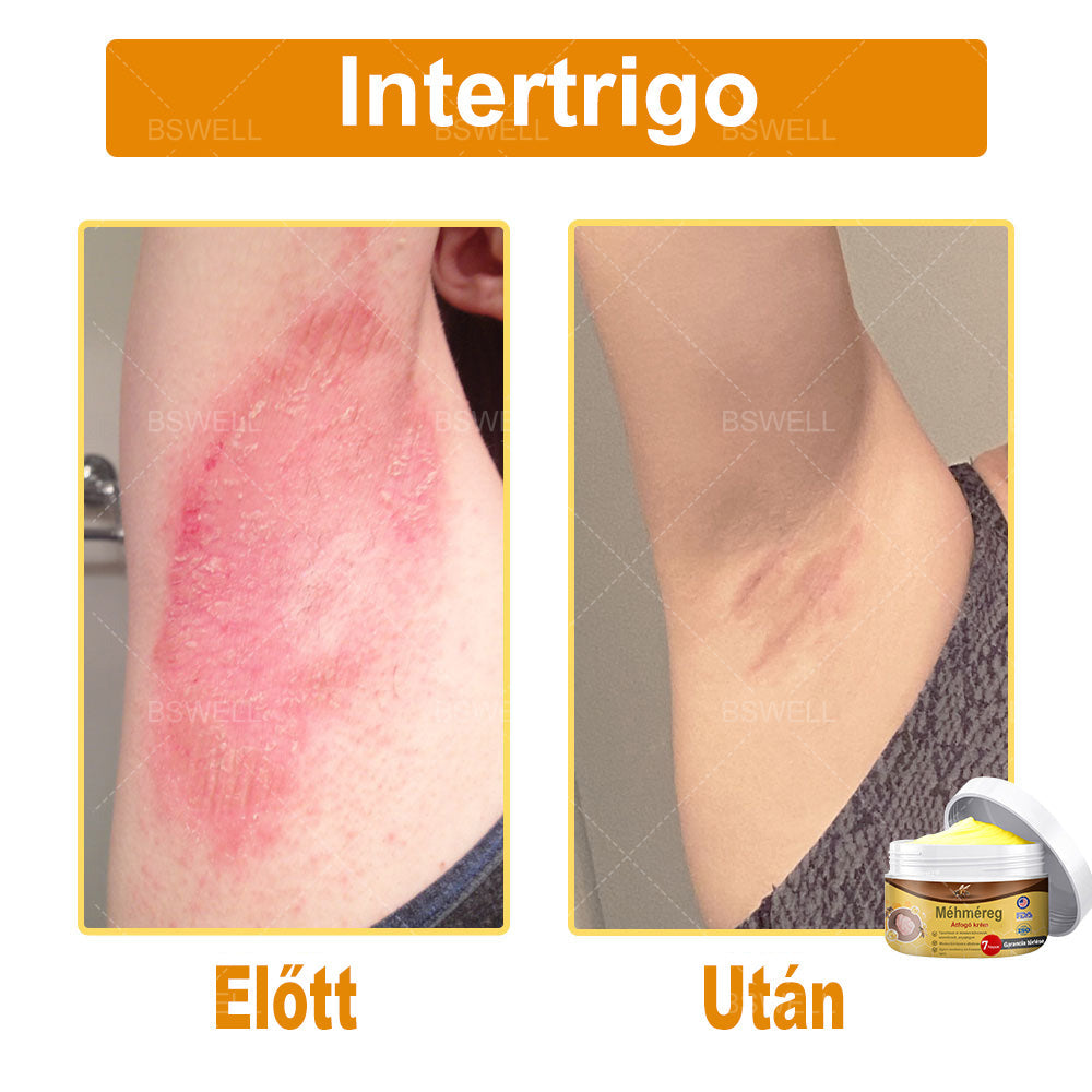 BSWELL® Méhméreg átfogó krém 🌿 AAD jóváhagyott és ajánlott